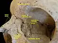 Cranium. Posterior lacrimal crest. Lacrimal bone.