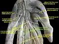 flexor tendon sinovial sheath of hand