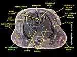 Infraspinatus muscle