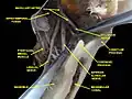 Deep dissection of the infratemporal fossa, showing the lingual and inferior alveolar nerve (anterolateral view)