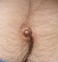 Sagittal hair growth above and below the navel