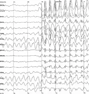 Graph showing 16 voltage traces going across the page from left to right, each showing a different signal. At the middle of the page all of the traces abruptly begin to show sharp jerky spikes, which continue to the end of the plot.