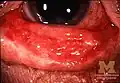 Conjunctivitis in SJS