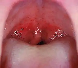 Mouth wide open showing the throatNote the petechiae, or small red spots, on the soft palate. This is an uncommon but highly specific finding in streptococcal pharyngitis.