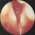 Grade 3 subglottic stenosis