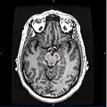 Horizontal MRI (T1 weighted) slice with highlighting indicating location of the substantia nigra.