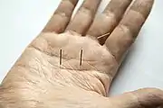 Sujichim, hand acupuncture