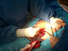 Suturing of the uterus