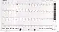 ECG showing sinus tachycardia and non-specific ST and T wave changes from a person with confirmed takotsubo cardiomyopathy