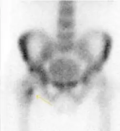 In this case, Tc 99 scintigraphy shows a band of uptake