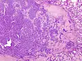 Micrograph of papillary thyroid carcinoma demonstrating prominent papillae with fibrovascular cores. H&E stain.