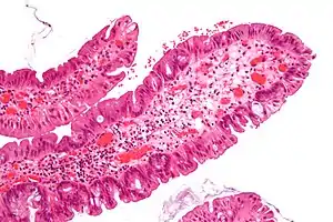 Traditional serrated adenoma. H&E stain.