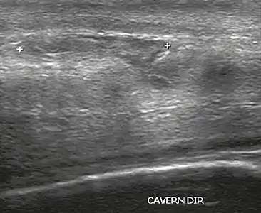 Figure 4 A: Ultrasound of the penis, right lateral view. Longitudinal section showing rupture of the tunica albuginea with an adjacent 1.92 cm hematoma (between calipers), due to trauma.