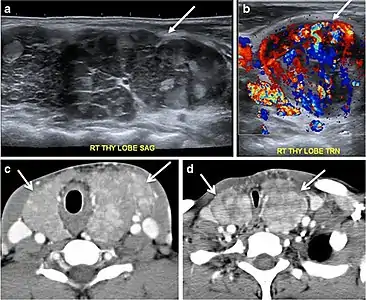 Fig. 14. A 19-year-old male patient known to have multi-nodular goiter and FNA, showing underlying Hashimoto's thyroiditis. a, b Sagittal and transverse greyscale and colour Doppler ultrasound of the neck demonstrate a hypoechoic enlarged right thyroid lobe with small hyperechoic regenerative nodules and marked hypervascularity (white arrows). c, d Enhanced axial CT scan images of the neck demonstrate a heterogeneously enhancing and enlarged thyroid gland, left more than right lobe, and the trachea is markedly narrowed.