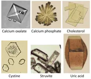 Comparison of different types of urinary stones.