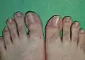 Healed ingrown toenail after Vandenbos procedure