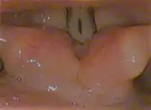 Phonating vocal folds