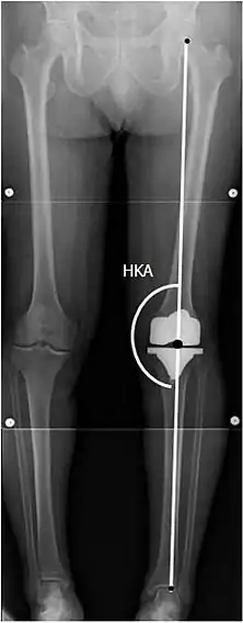 HKA: Hip-knee-ankle angle, which is ideally between 3° varum to 3° valgum from a right angle.